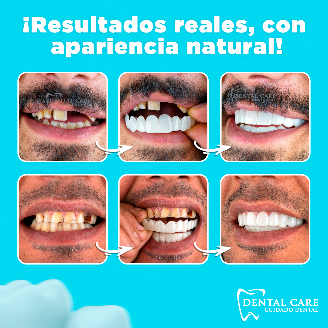 Carillas Dentales Naturales Removible - Llévate 2 Kits Paga 1